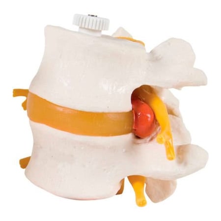 Fabrication Enterprises 3B Anatomical Model - 2 Lumbar Vertebrae with Prolapsed Disc, Flexibly Mounted 984665